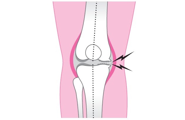 筋膜整体＆経絡指圧　東御　整体　ほぐしや 膝痛について