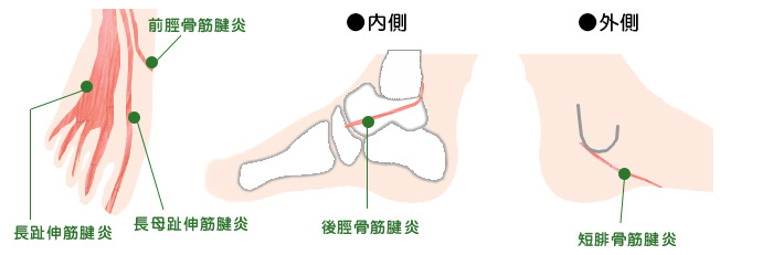 東御市,上田市,小諸市,整体,指圧,ほぐしや,ランニング時の膝の痛み原因と対策